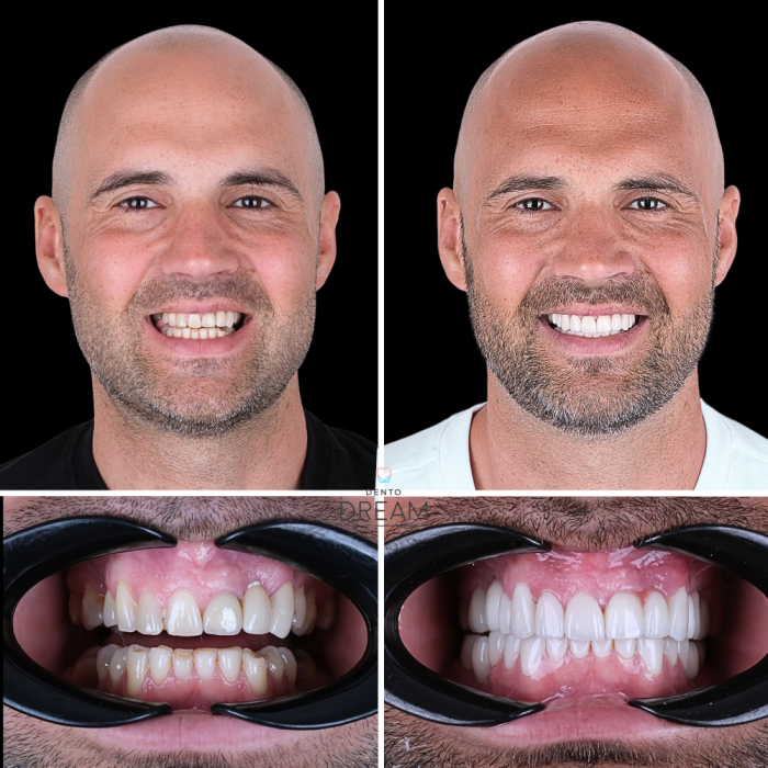 Before and after dental smile case 1