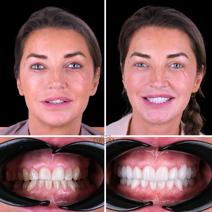 Before and after dental smile case 10