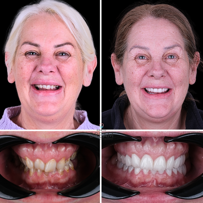 Before and after dental smile case 14
