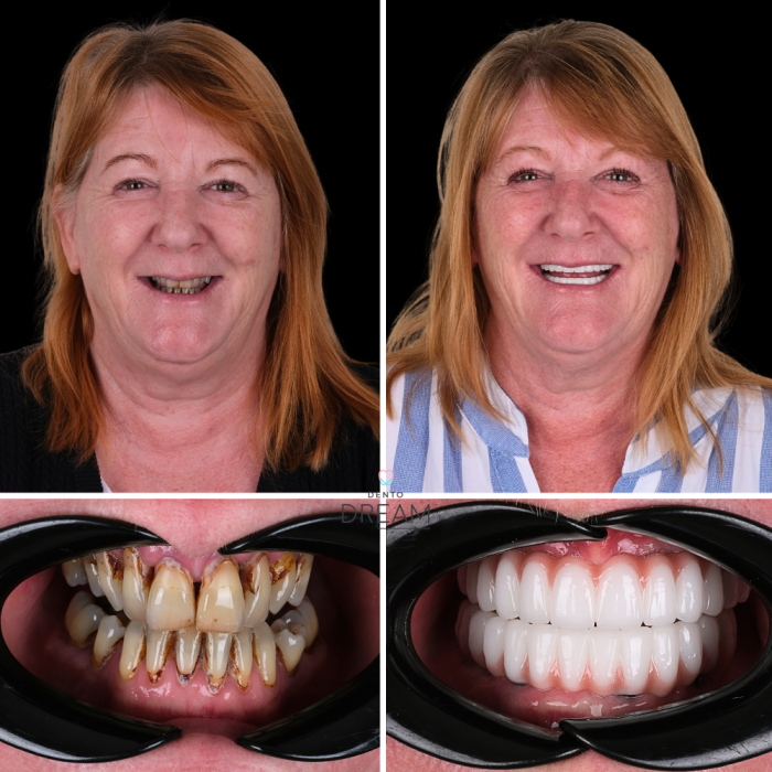 Before and after dental smile case 7