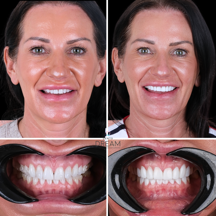 Before and after dental smile case 8